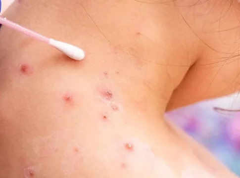 Las diferencias entre la emergencia por la viruela del mono y el covid