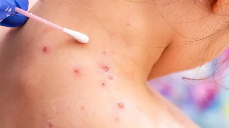 Las diferencias entre la emergencia por la viruela del mono y el covid