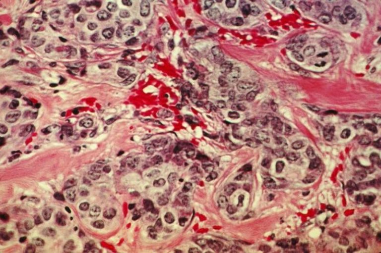El CNIO da con una pista clave sobre el cáncer de mama más frecuente
