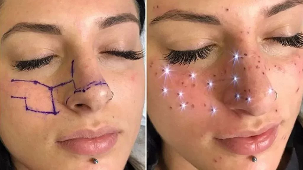 ¿Qué es el freckling?