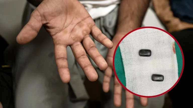 Se implanta imanes en los dedos para hacer trampas en un juego de dados durante 40 años