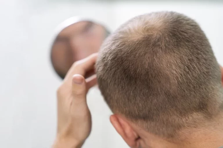 Este gel frena la alopecia mejor que el finasteride y el minoxidil