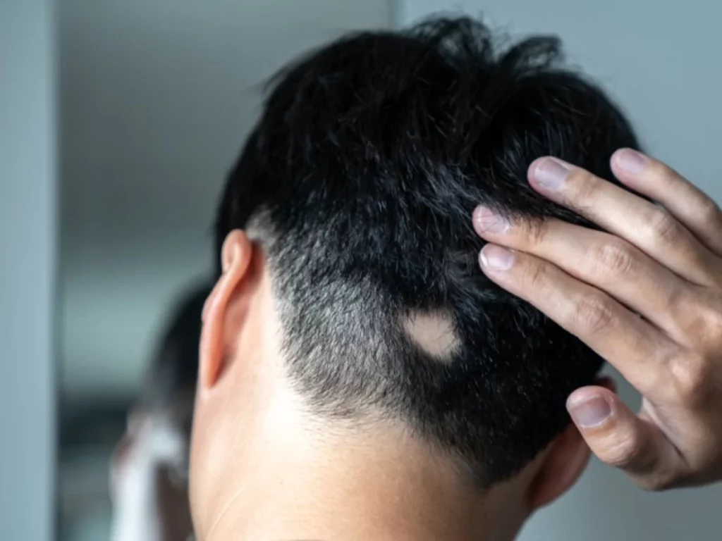 Este gel frena la alopecia mejor que el finasteride y el minoxidil 68 Ventajas frente a los tratamientos tradicionales