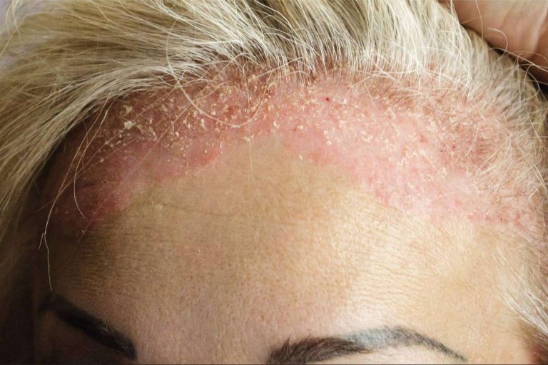 Qué es la foliculitis; causas, factores y prevención para el invierno