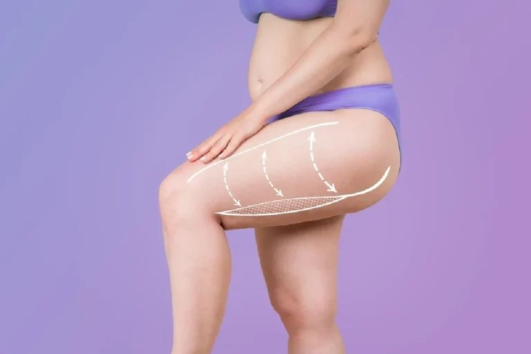 Claves para identificar síntomas del lipedema, una enfermedad desconocida