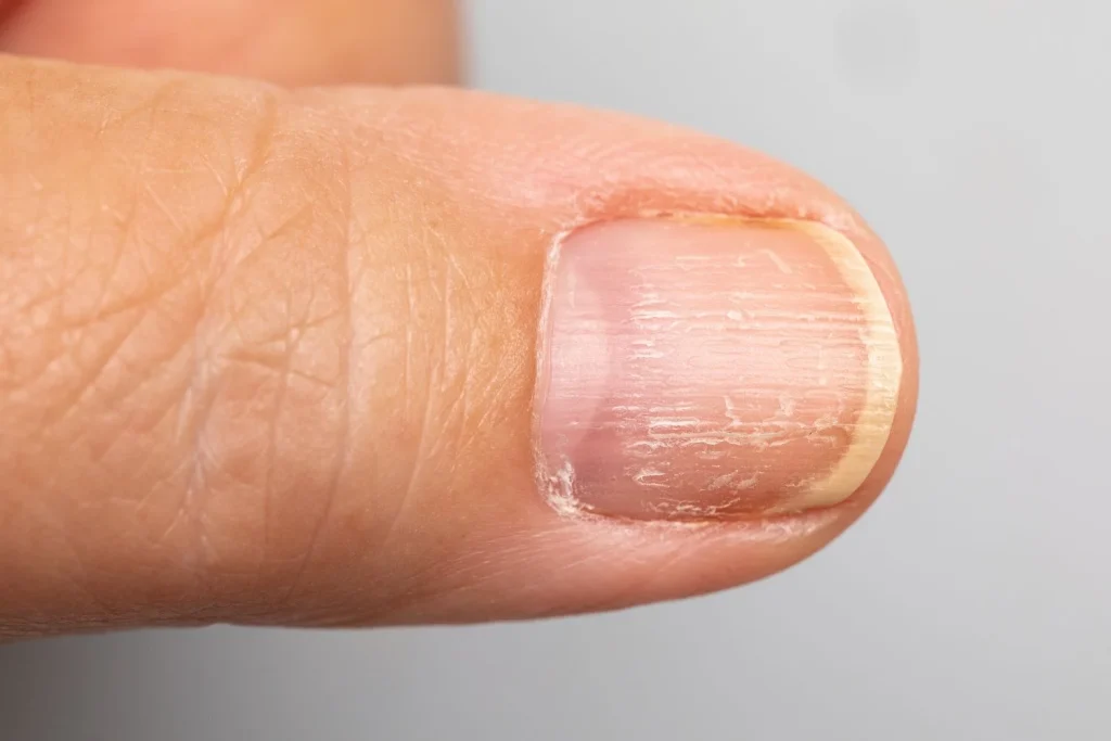 OTROS SÍNTOMAS QUE ACOMPAÑAN A LAS ALTERACIONES EN LAS UÑAS