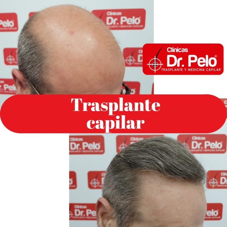 injertos para alopecia severa desde 20.000 € – Noticias Empresariales