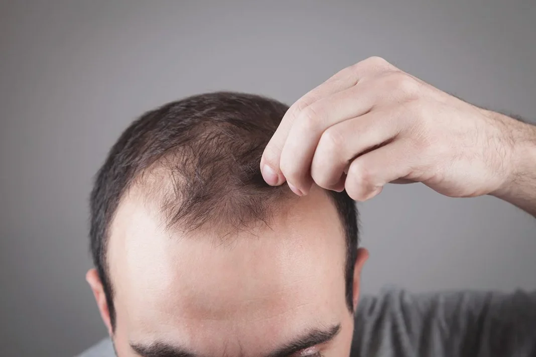 BUENOS RESULTADOS DE ESTA TERAPIA CONTRA LA ALOPECIA
