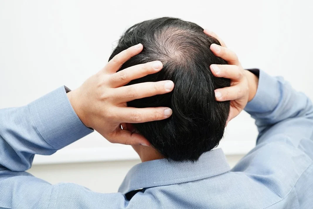 CAUSAS DE ALOPECIA