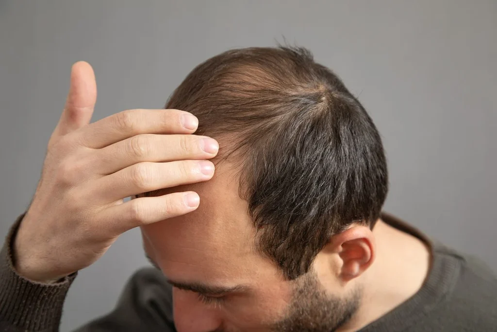 LA ALOPECIA AFECTA TANTO A HOMBRES COMO A MUJERES