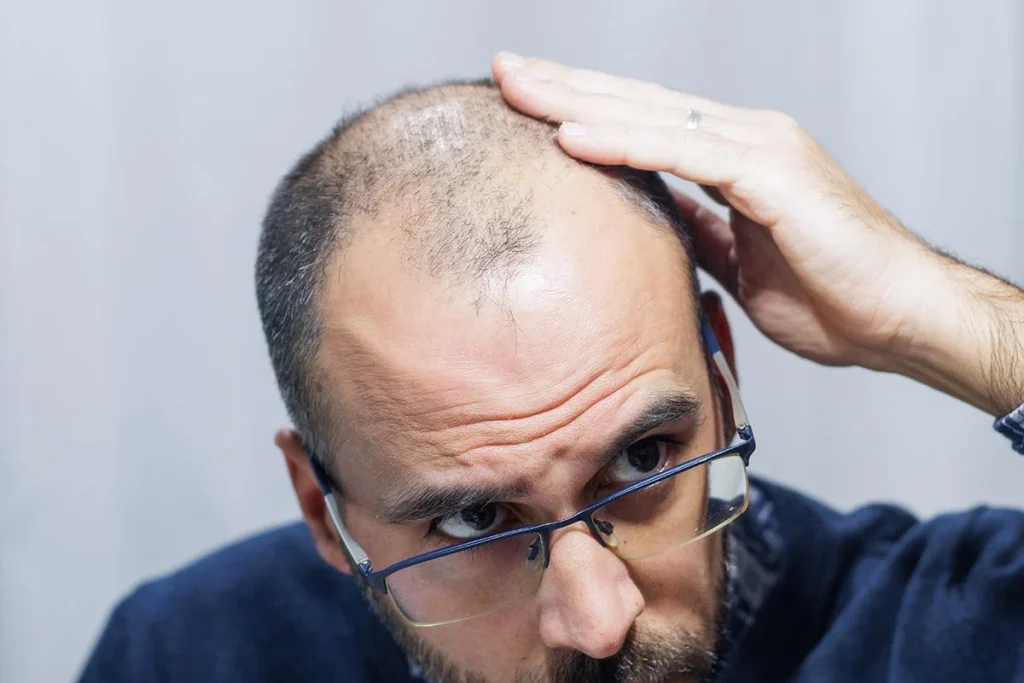 LAS CÉLULAS MADRE AYUDAN A COMBATIR LA ALOPECIA