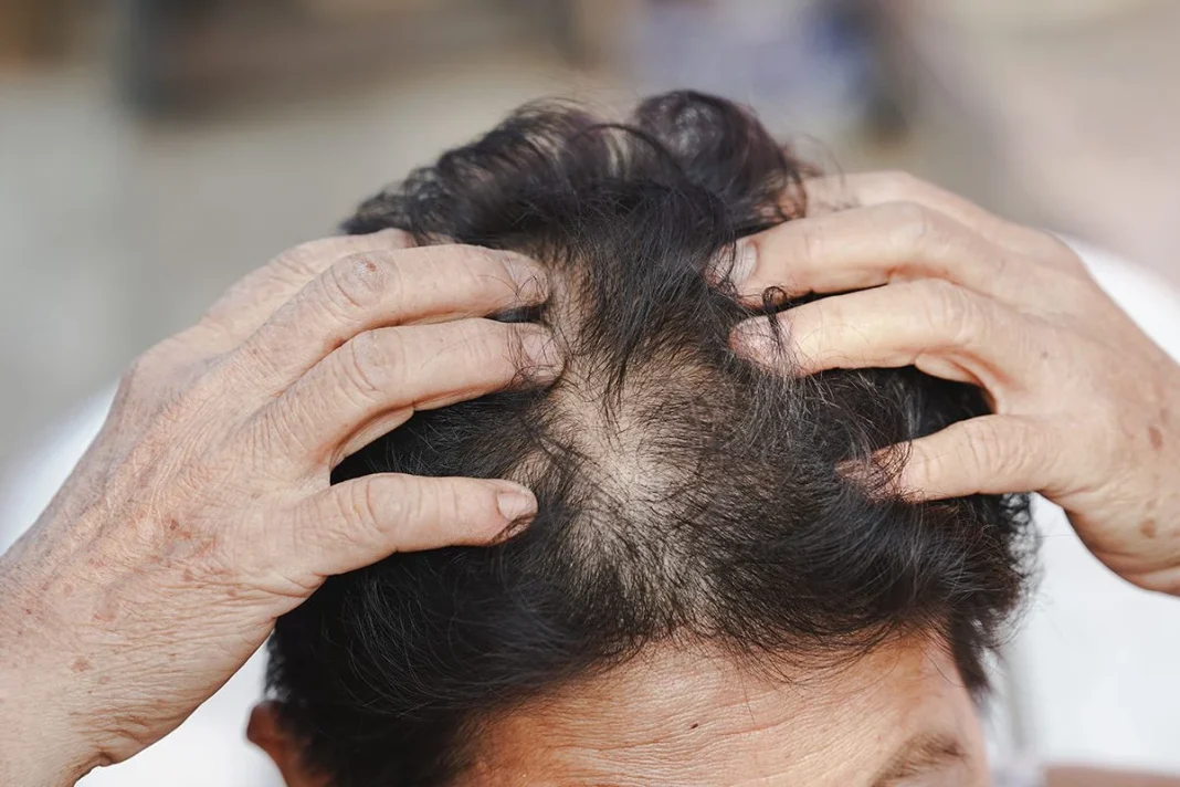 TRATAR LA ALOPECIA EN HUMANOS