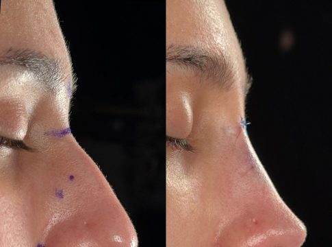 Rinoplastía Ultrasónica Rinoplastía Ultrasónica