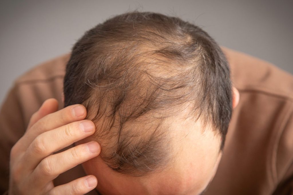CASI LA MITAD DE LOS HOMBRES ESPAÑOLES SUFREN ALOPECIA
