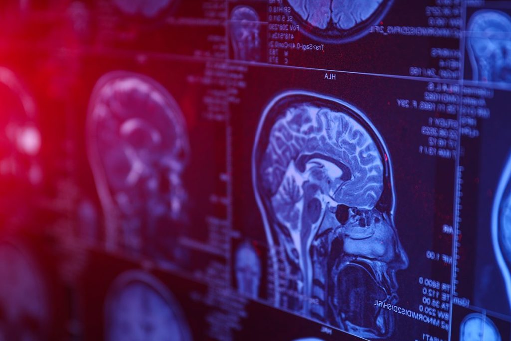 CLAVE PARA ESTUDIAR ENFERMEDADES QUE AFECTAN AL CEREBRO