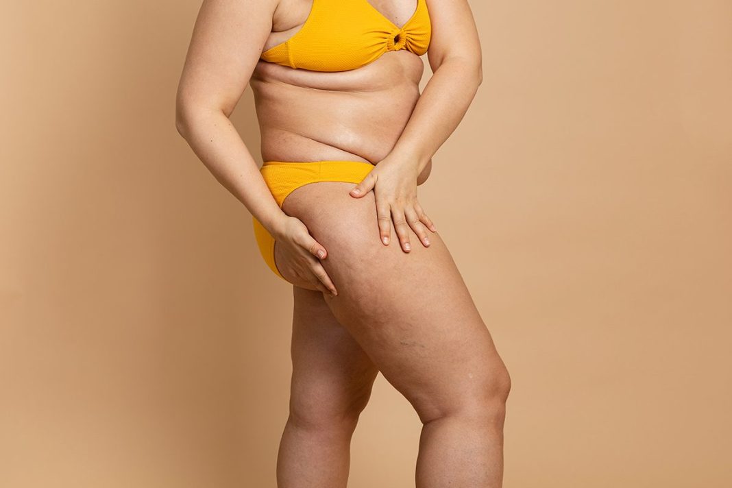 CÓMO FUNCIONA ESTE MÉTODO CONTRA LA GRASA LOCALIZADA