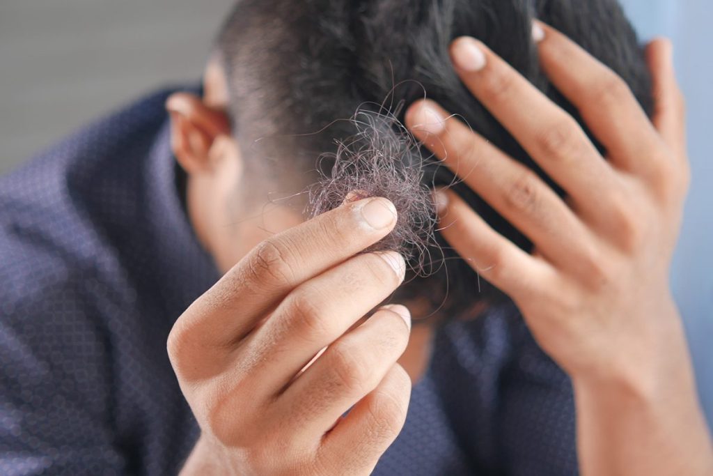 LA ALOPECIA ANDROGÉNICA ES LA MÁS COMÚN