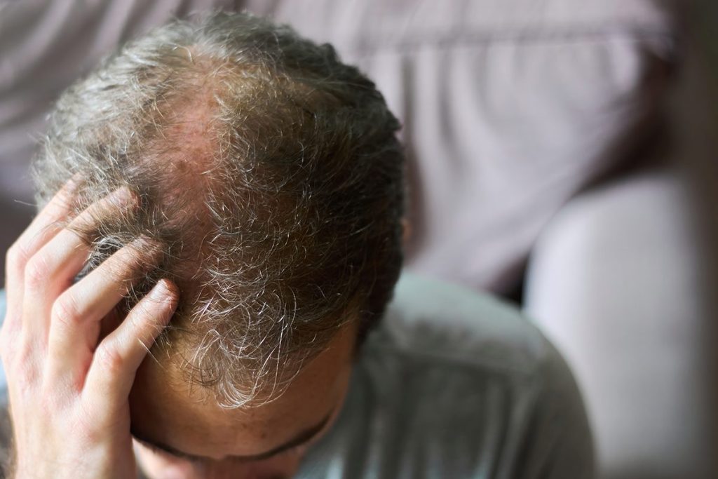 LA IA AYUDA A ACABAR CON LA ALOPECIA