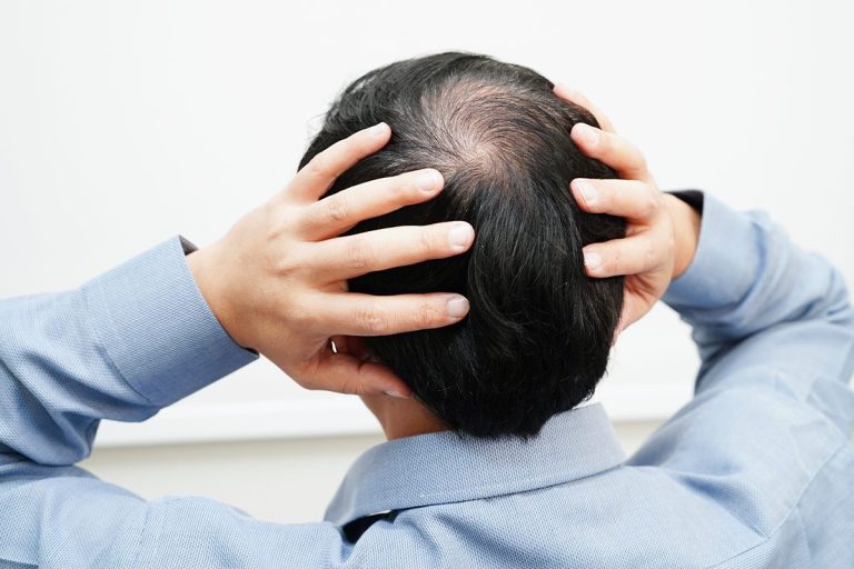 La IA que promete curar la alopecia: Así funciona el robot ARTAS iX que te devuelve el cabello