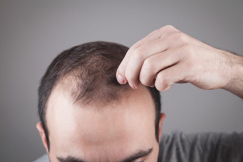 OTROS TIPOS DE ALOPECIA