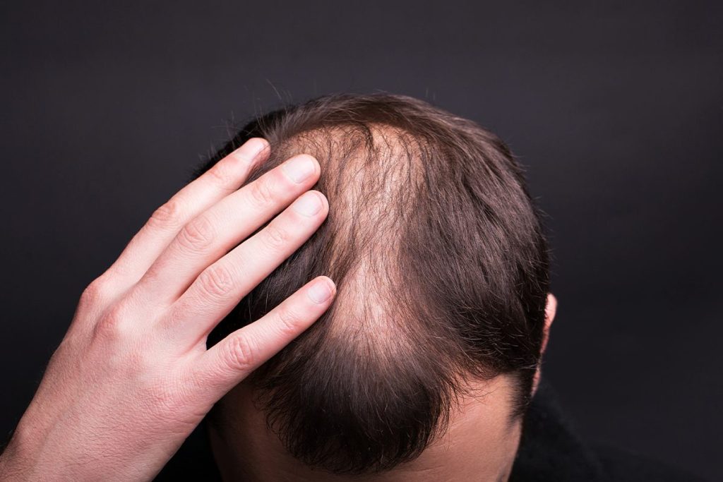 RESULTADOS MUY NATURALES FRENTE A LA ALOPECIA