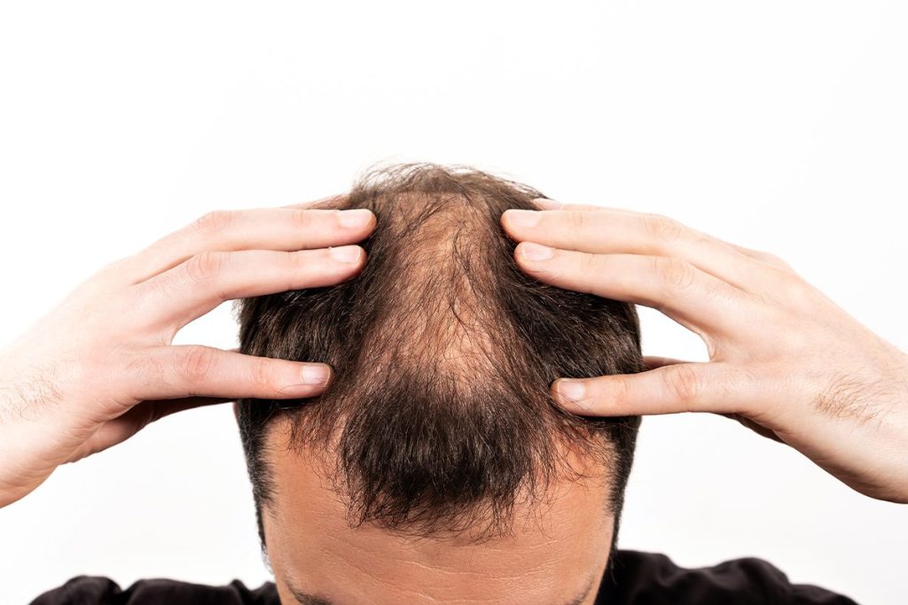 ¿CUÁNTO CUESTA ESTE TRATAMIENTO CONTRA LA ALOPECIA?