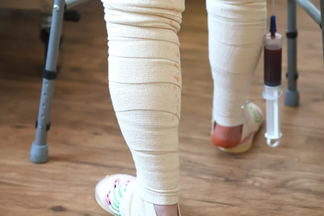 UN AVANCE CON UN GRAN IMPACTO PARA TRATAR PROBLEMAS DE HUESOS