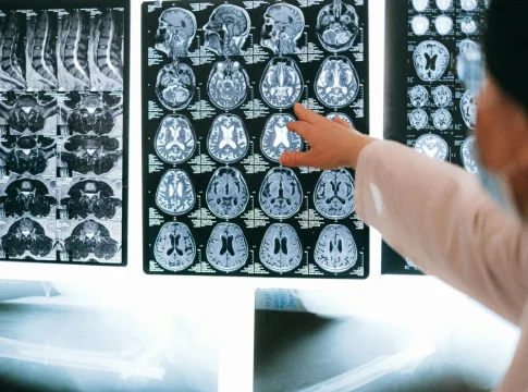daño cerebral adquirido ictus Una doctora señalando daño cerebral adquirido tras un ictus