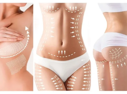 La inversión maestra en belleza. Mommy Makeover y la liposucción. La inversión maestra en belleza. Mommy Makeover y la liposucción.