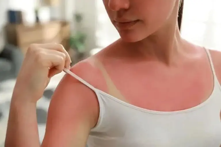 El peligro detrás de los tatuajes solares: cuando una moda se convierte en una quemadura