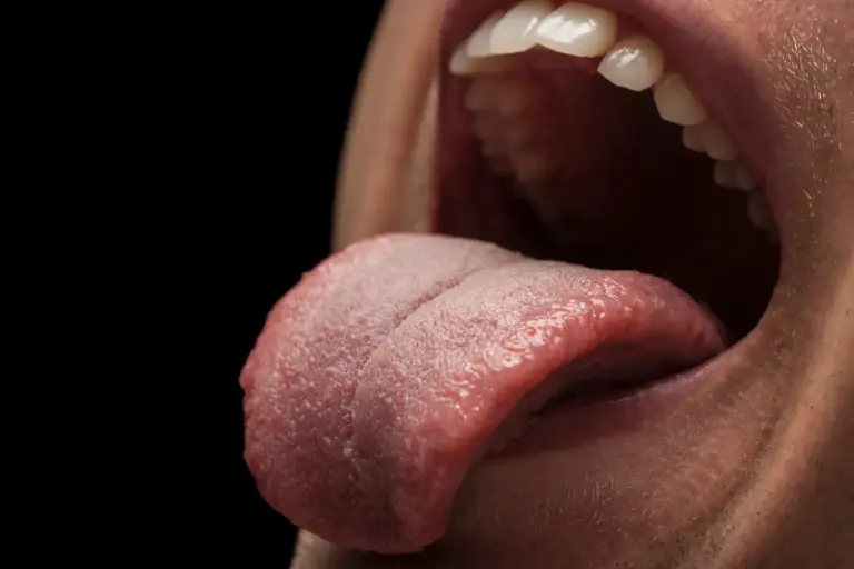 La lengua blanca y saburral: cómo identificar la candidiasis oral que aparece tras los antibióticos