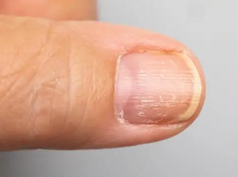 Manchas blancas o uñas amarillas: lo que tus uñas revelan sobre tu salud y que los dermatólogos advierten Manchas blancas o uñas amarillas: lo que tus uñas revelan sobre tu salud y que los dermatólogos advierten