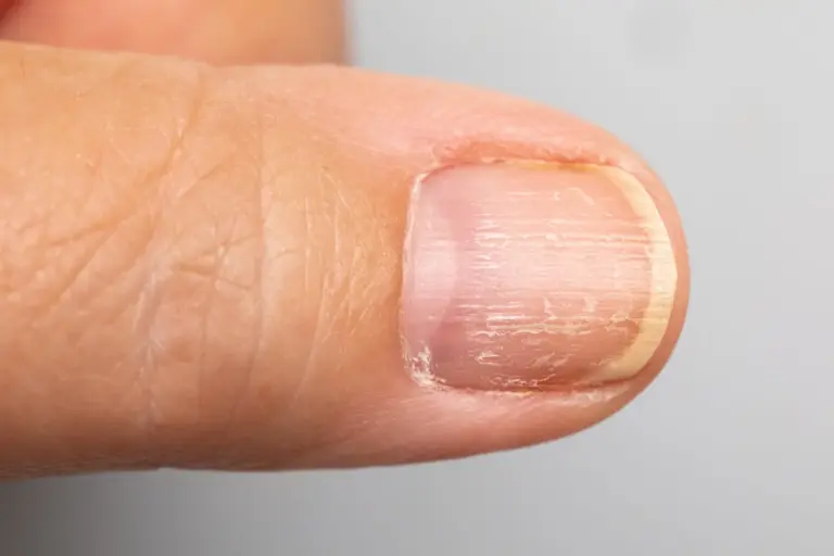 Manchas blancas o uñas amarillas: lo que tus uñas revelan sobre tu salud y que los dermatólogos advierten